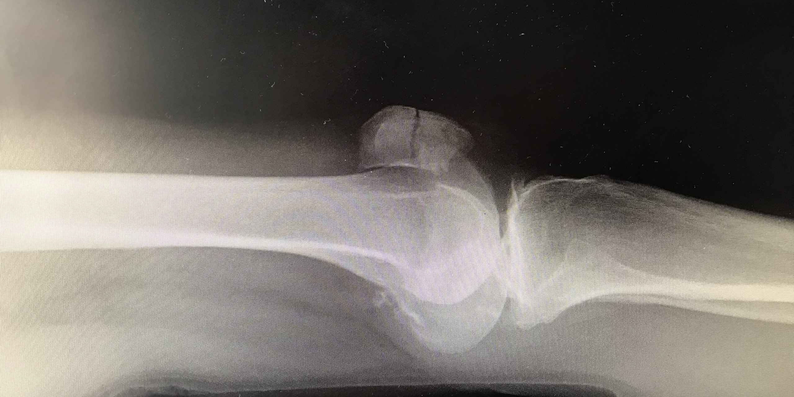 skiing after broken kneecap