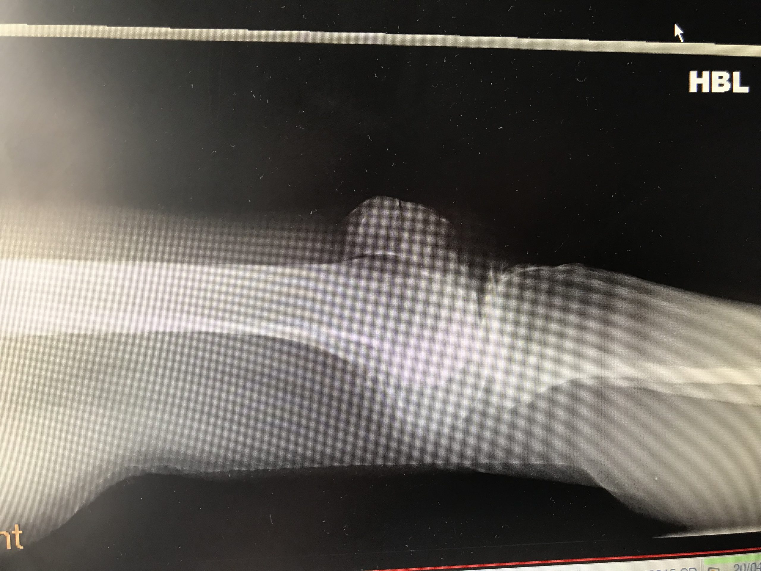 20_01_broken kneecap skiing after broken kneecap